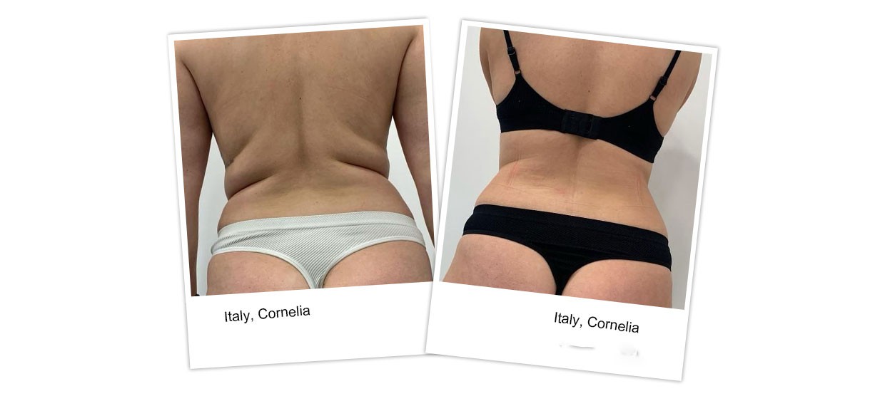 Before--After45 Before--After45